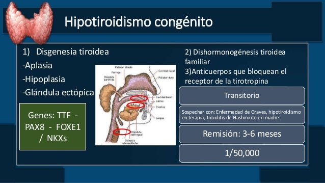 disgenesia tiroidea